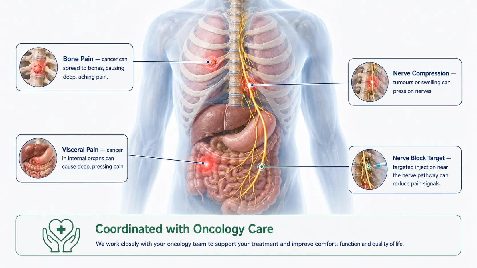 Cancer-Related Pain anatomy illustration